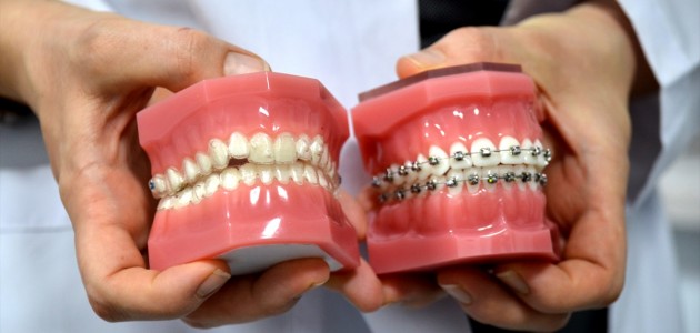  Diş Teli Tedavisinin Zahmetine 'Şeffaf Plak' Son Veriyor